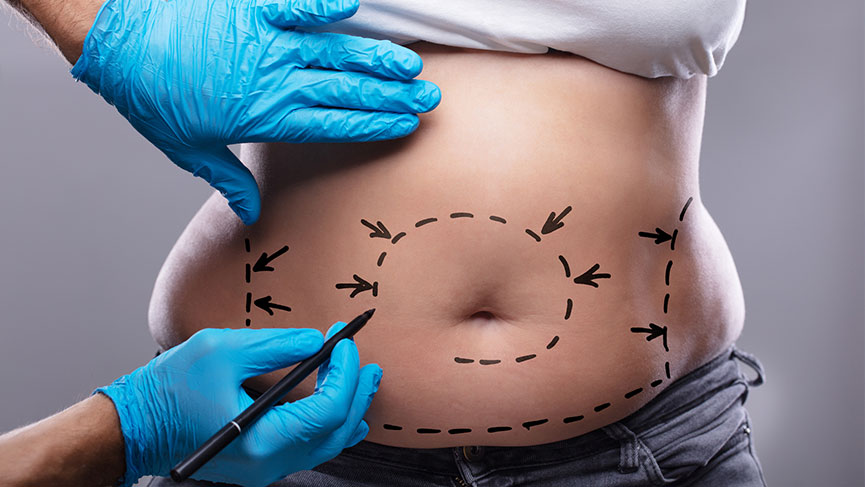 Your Personalized Liposuction Journey Begins Here