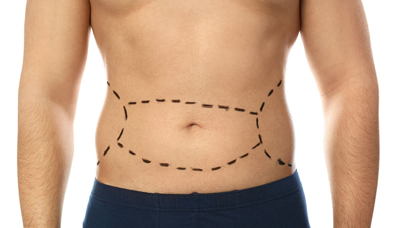 The Liposuction Turkey Price Advantage at Vive Hospital