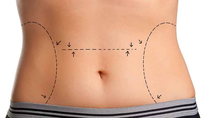 Comprehensive Lipo in Turkey Cost Breakdown