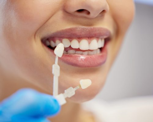 Veneers vs. Crowns: Which One is Right for You?
