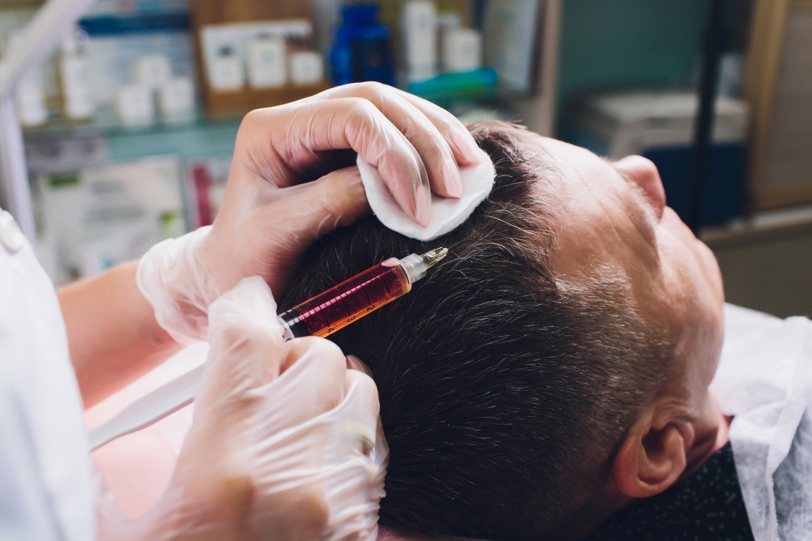 Treatment of baldness with beauty injections. Cosmetologist hands in gloves make a subcutaneous injection. Plasmalifting male patient